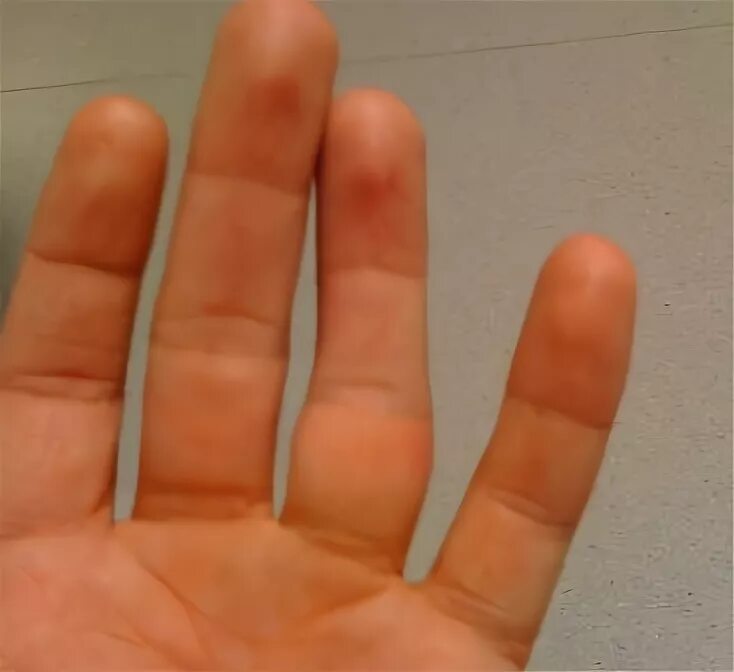 Ring fingers and pinky fingers should be buddy taped together Finger injury, Jam