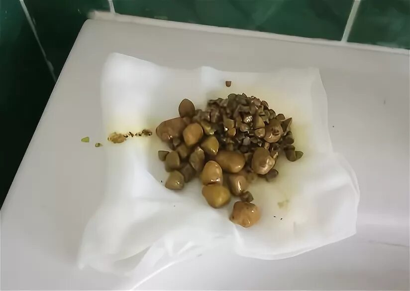 Билирубиновые камни в желчном пузыре. Камушки в желчном пузыре. Желчекаменная болезнь камни. Конкременты желчного пузыря что это такое. Камни в желчном 2 см.