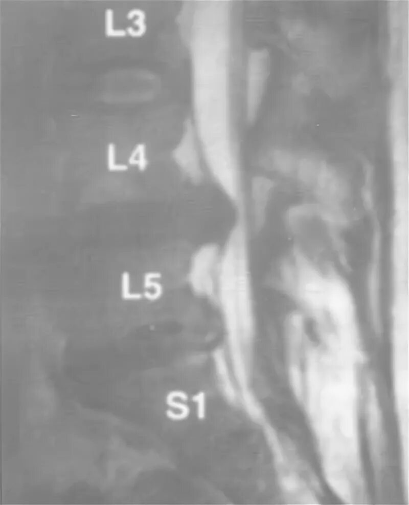 Грыжа диска l5 s1 что это. Грыжа дисков l5-s1. Межпозвонковые диски l4-l5. Грыжи дисков l4-5,l5-s1. Циркулярное выбухание диска l4/l5..