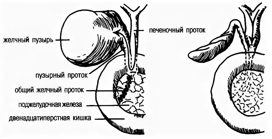 Симптом курвуазье это. Симптом курвуазье желчный пузырь. культя желчного протока. избыточная культя пузырного протока. симптом курвуазье поджелудочной железы.