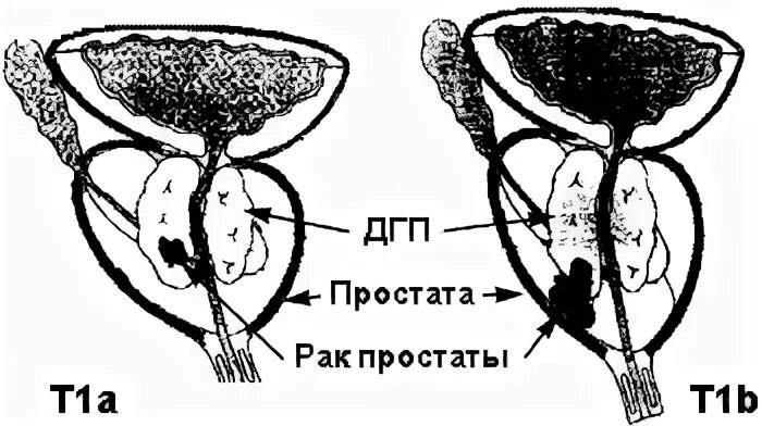 Простатит кальцинаты