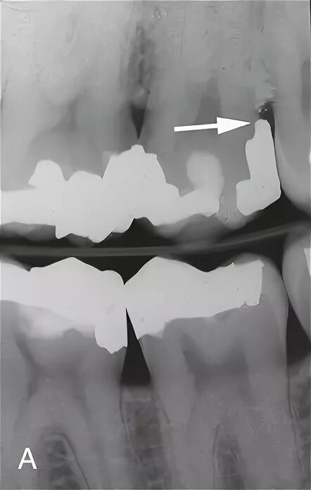 Плотный отсутствие. Нависабщий край поомба. Нависающий край пломбы зуба. Поддесневой зубной камень на рентгене.