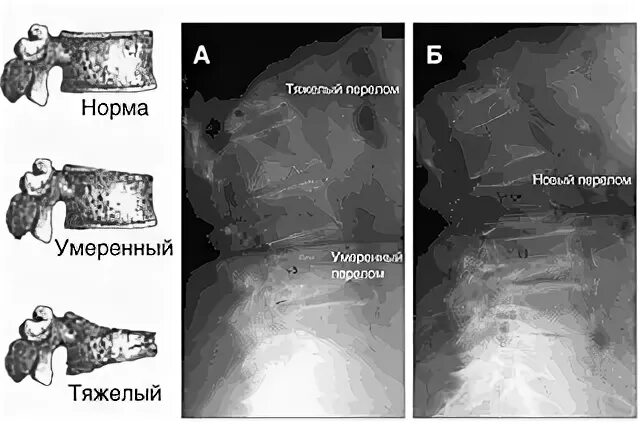 Рентгенография черепа турецкое седло. Изменения турецкого седла на рентгене. Рентгеновский снимок турецкого седла. Остеопороз стенки турецкого седла. Остеопороз спинки.