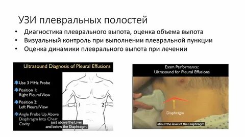 Узи плевральной полости