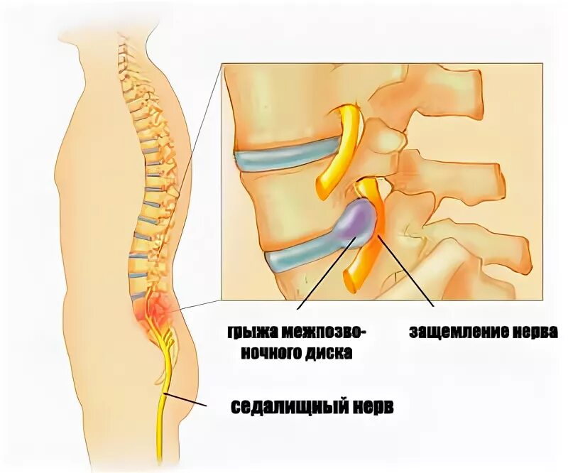 Зажало нерв в пояснице. Защемление тазобедренного нерва. Защемило нерв в пояснице. Защемление поясничного нерва.
