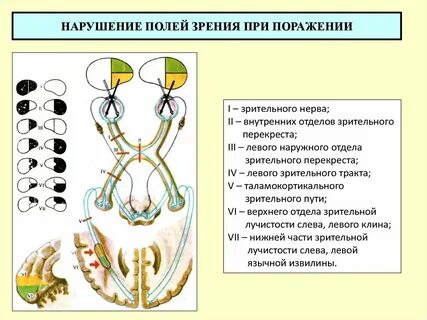Поражение зрительных путей