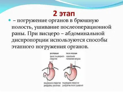 Грыжа сердца