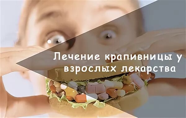 Чем лечат крапивницу препараты