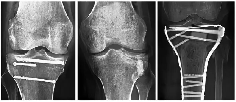 Перелом дистального метаэпифиза большеберцовой кости. Перелом дистального эпиметафиза большеберцовой кости. Перелом мыщелка большеберцовой кости. Перелом проксимального эпиметафиза большеберцовой кости. Остеосинтез мыщелка