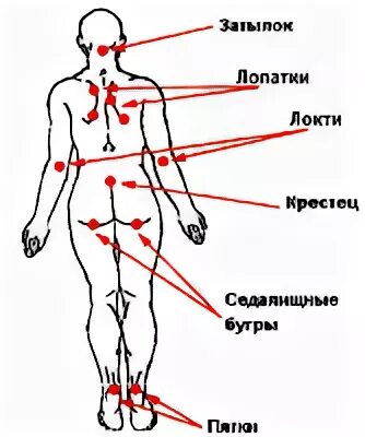 Пролежни в положении на боку. Места образования пролежней на спине на боку сидя. места образования пролежней в положении лежа на спине. пролежни в положении на спине. места локализации пролежней.