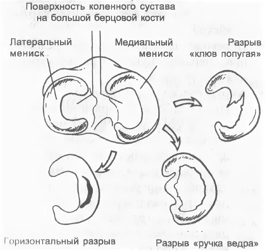 Разрыв мениска код