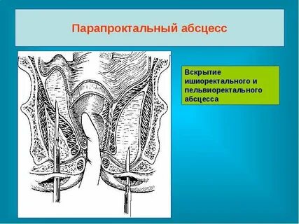 Ишиоректальный парапроктит