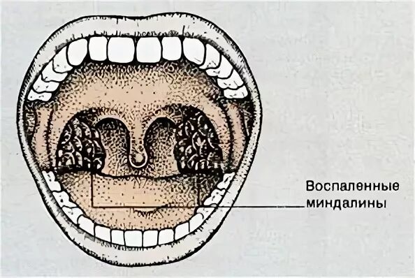 Миндалин белгород. Клиническая анатомия небных миндалин. лакуны миндалин строение. лимфоидная ткань на миндалине.
