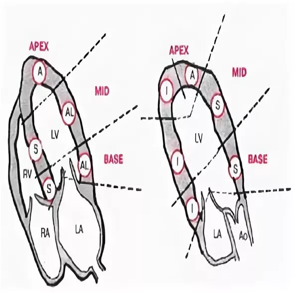 Локальная сократимость левого желудочка. Асинергия миокарда лж это. Зоны нарушения локальной сократимости миокарда лж. Нарушение локальной сократимости на ЭХОКГ. Сегменты миокарда левого желудочка схема.