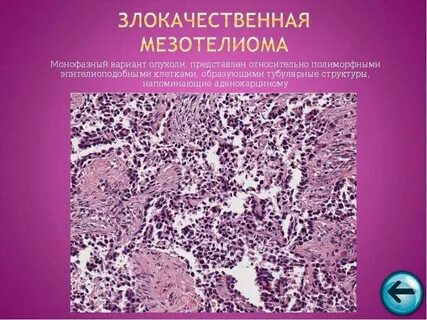 Мезотелиома брюшины