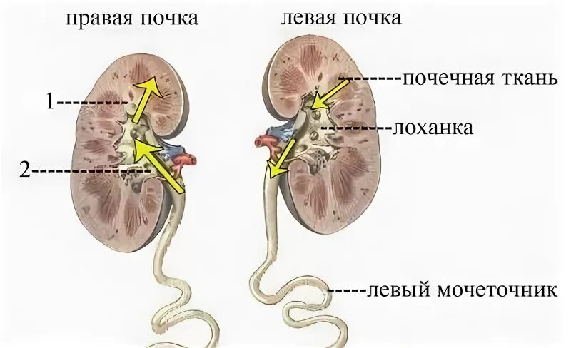 Пиелонефрит левой почки. Воспаление почечной лоханки.