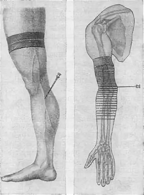 Наркоз ноги. Наркоз ноги. Внутривенная общая анестезия. Блокада плечевого сплетения по куленкампфу техника. Проводниковая анестезия при пхо ран предплечья.
