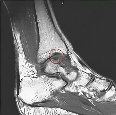 Асептический некроз таранной кости мрт. Рассекающий остеохондрит таранной кости голеностопного сустава. Некроз таранной кости голеностопного сустава мрт. Асептический некроз таранной кости голеностопного сустава мрт.