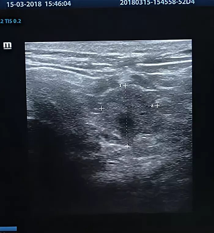 фиброма мягких тканей на узи