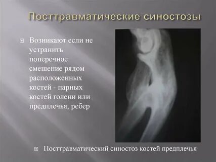 Пар костей