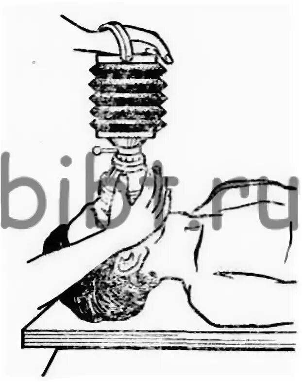 Удаление воздуха из желудка при искусственном дыхании. РПА искусственное дыхание. Схема аппарата для искусственного дыхания ДП-2. Искусственное дыхание по методу Сильвестра. Искусственное дыхание и непрямой массаж сердца.