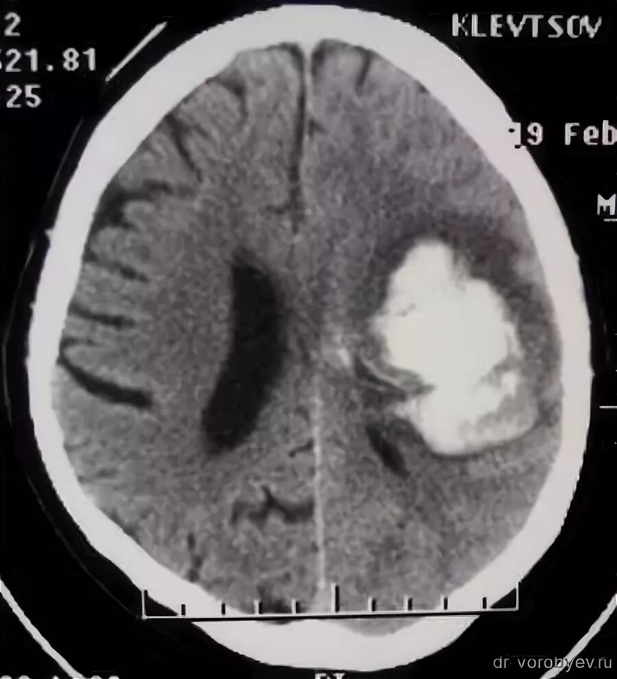 Левая гемисфера головного мозга. Путаменальная гематома. Гемисферы головного мозга. Субкортикальная гематома. Путаменальная гематома на кт.
