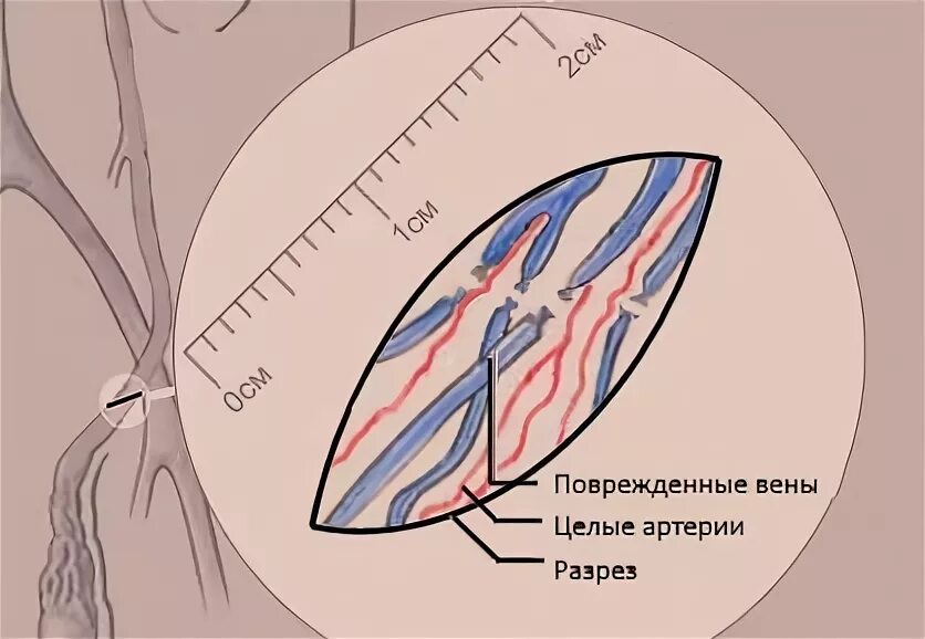 Варикоцеле: причины, симптомы и лечение в статье андролога Рыжков А. И.