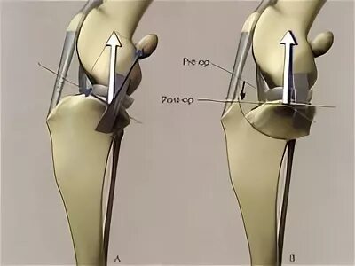 Пкс коленного сустава у собак. Остеотомия коленного сустава у собаки. Операция собаки разрыв связки. Операция собаки разрыв связки. Разрыв крестообразной связки коленного сустава у собак.