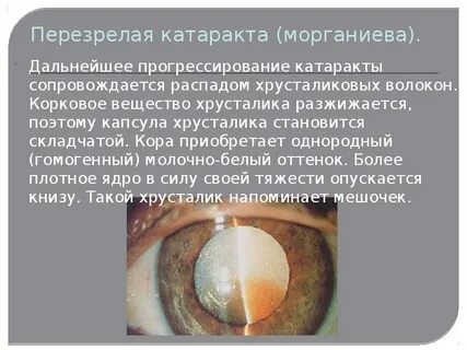 Катаракта кто делал отзывы