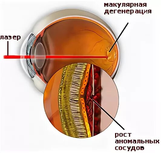 Лазерной коагуляции сосудов сетчатки. Дистрофия сетчатки глаза операция лазером. Приваривание лазером отслоившейся сетчатки глаза.