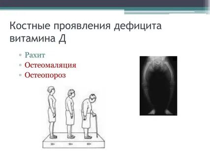 Остеопороз при недостатке витамина