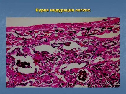 Бурая индурация легких