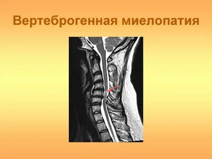 Миелопатия спинного мозга