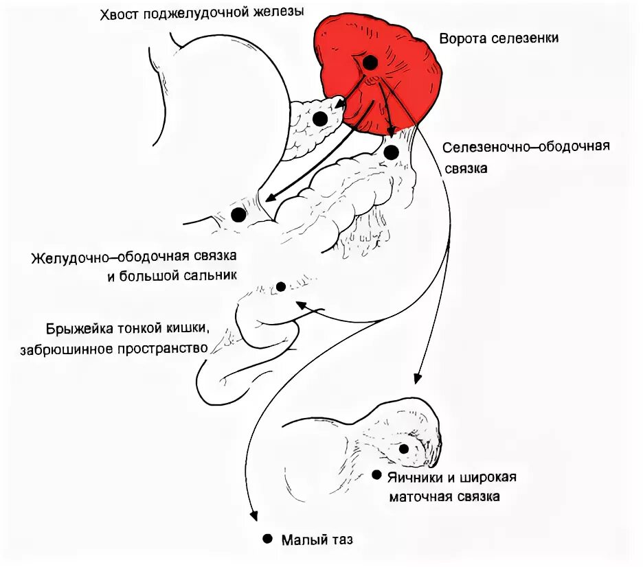 Спленэктомия селезенки. Добавочная долька селезенки.