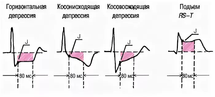 Депрессия сегмента st. Депрессия сегмента St на ЭКГ точка j. Точки j и i на ЭКГ. Косонисходящая депрессия сегмента St на ЭКГ. Точка i на ЭКГ.