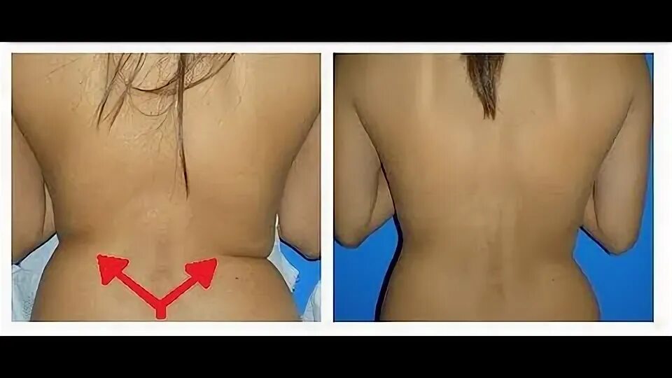 Похудела с помощью массажа
