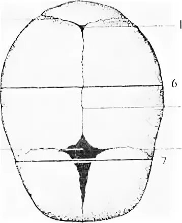 Стреловидный шов черепа у ребенка. Стреловидный шов новорожденного. Теменные кости плода.