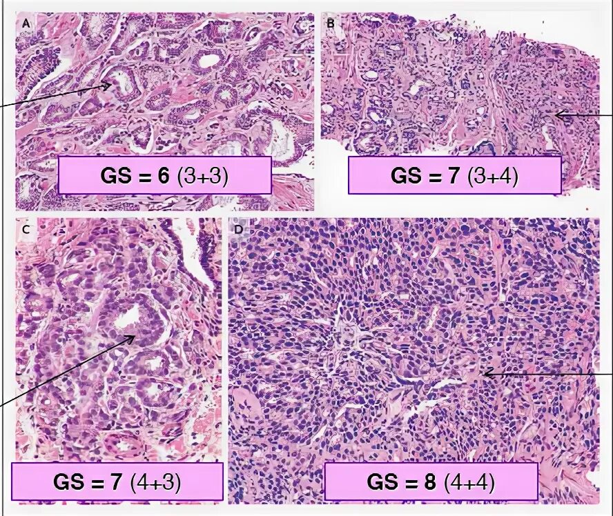 Ацинарная аденокарцинома простаты гистология. Мелкоацинарная аденокарцинома гистология. Аденокарцинома предстательной железы Глисон. Карцинома предстательной железы гистология. Ацинарная аденокарцинома предстательной железы глисон 7