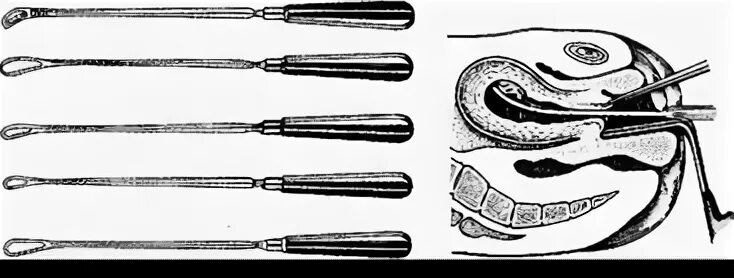 Как называется выскабливание. Раздельное диагностическое выскабливание полости матки. Выскабливание слизистой оболочки матки. Хирургическое выскабливание полости матки. Диагностическое выскабливание полости матки алгоритм.