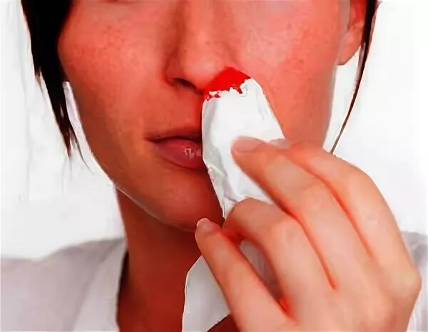 Кровь из носа при беременности. Кровотечение из носа при беременности. Капиллярные носовые кровотечения возникают из. Идет носом кровь у беременной