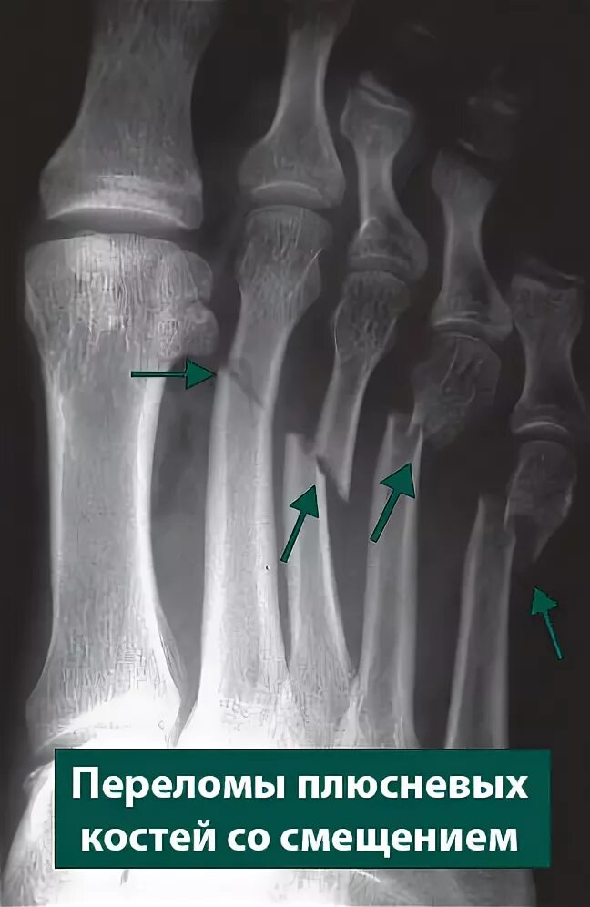 Перелом кости стопы сколько заживает у взрослых. Диафиза 5 плюсневой кости. Перелом диафиза 3 плюсневой кости. Перелом метаэпифиза плюсневой кости. 4 Плюсневая кость стопы перелом.