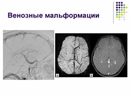 Венозный инсульт