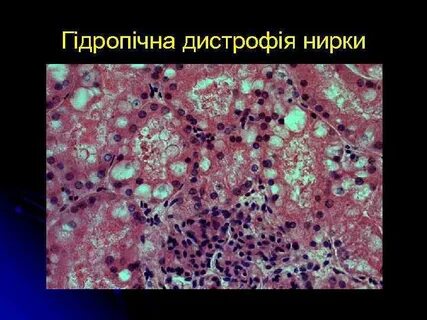 Белковая дистрофия печени