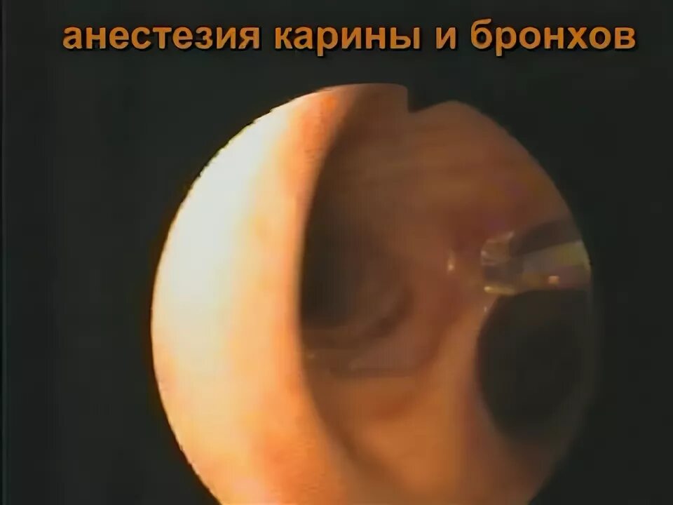 Диффузный эндобронхит. Атрофический эндобронхит. катаральный эндобронхит. катарально гнойный эндобронхит.