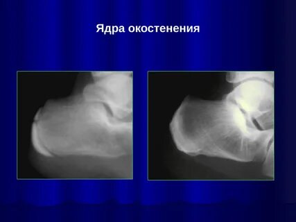 Ядра окостенения тазобедренных суставов у детей