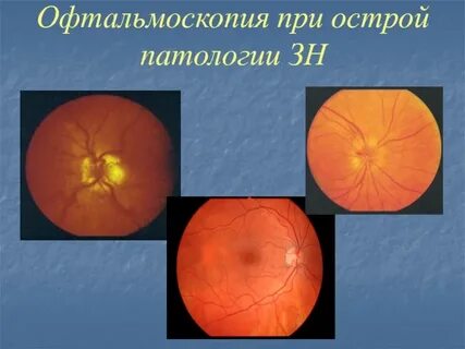 Туберкулезный папиллит