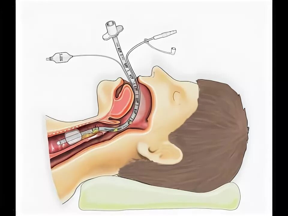 Трубка при наркозе. Интубация трахеи наркоз. Анестезия: эндотрахеальный наркоз.. Эндотрахеальный метод наркоза. Эндотрахеальная трубка для наркоза.