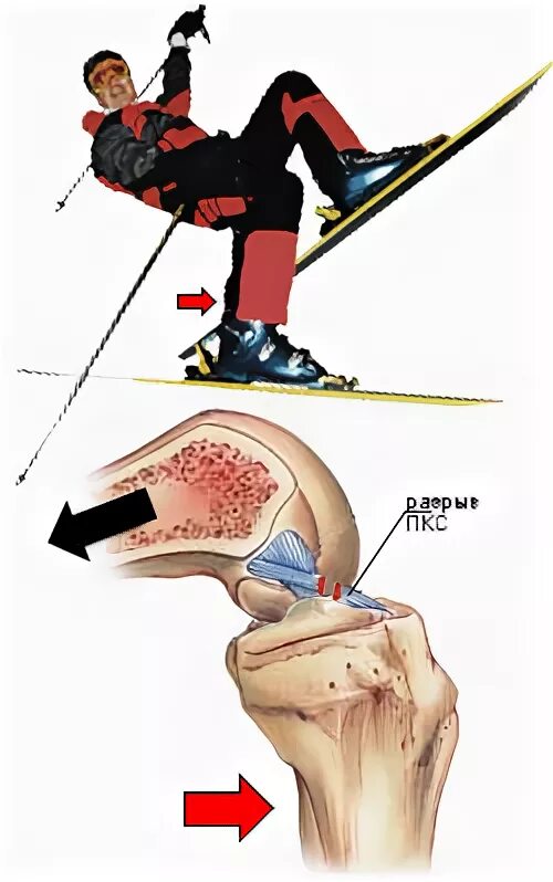 Разрыв связок ПКС коленного сустава. Механизм травмы передней крестообразной связки коленного сустава. Передняя крестообразная связка коленного сустава разрыв. Механизм повреждения связок коленного сустава.