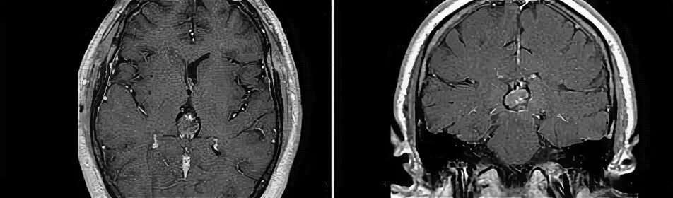 Герминома пинеальной области. Герминогенная несеминомная опухоль кт. Герминома