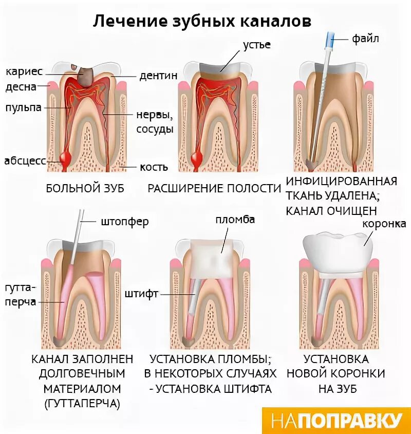Сколько ходят с лекарством в зубе